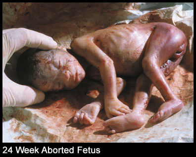 24 week aborted baby