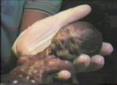 abortion picture 4