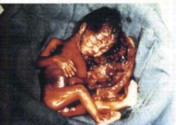abortion picture 6