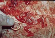 abortion picture 7