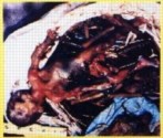 abortion picture 11
