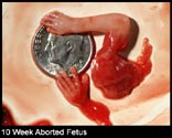 abortion picture 30