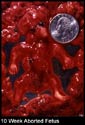 abortion picture 32