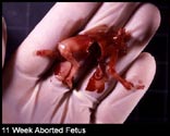 abortion picture 33