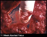 abortion picture 34
