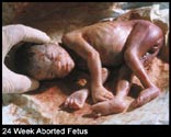 abortionpicture 36